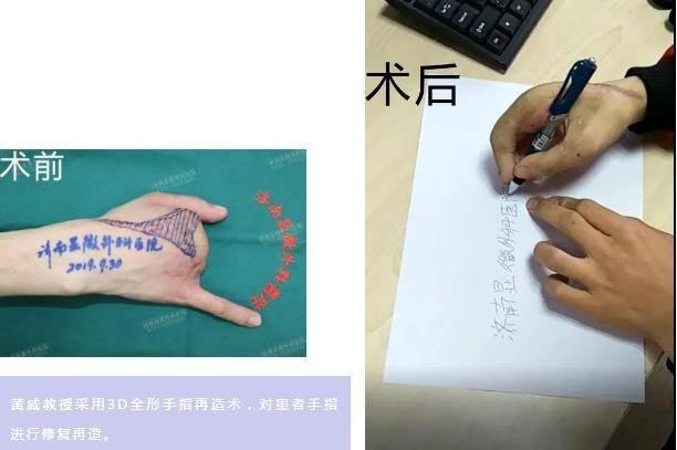 医学进步下的伦理挑战，最新食指再造技术探讨