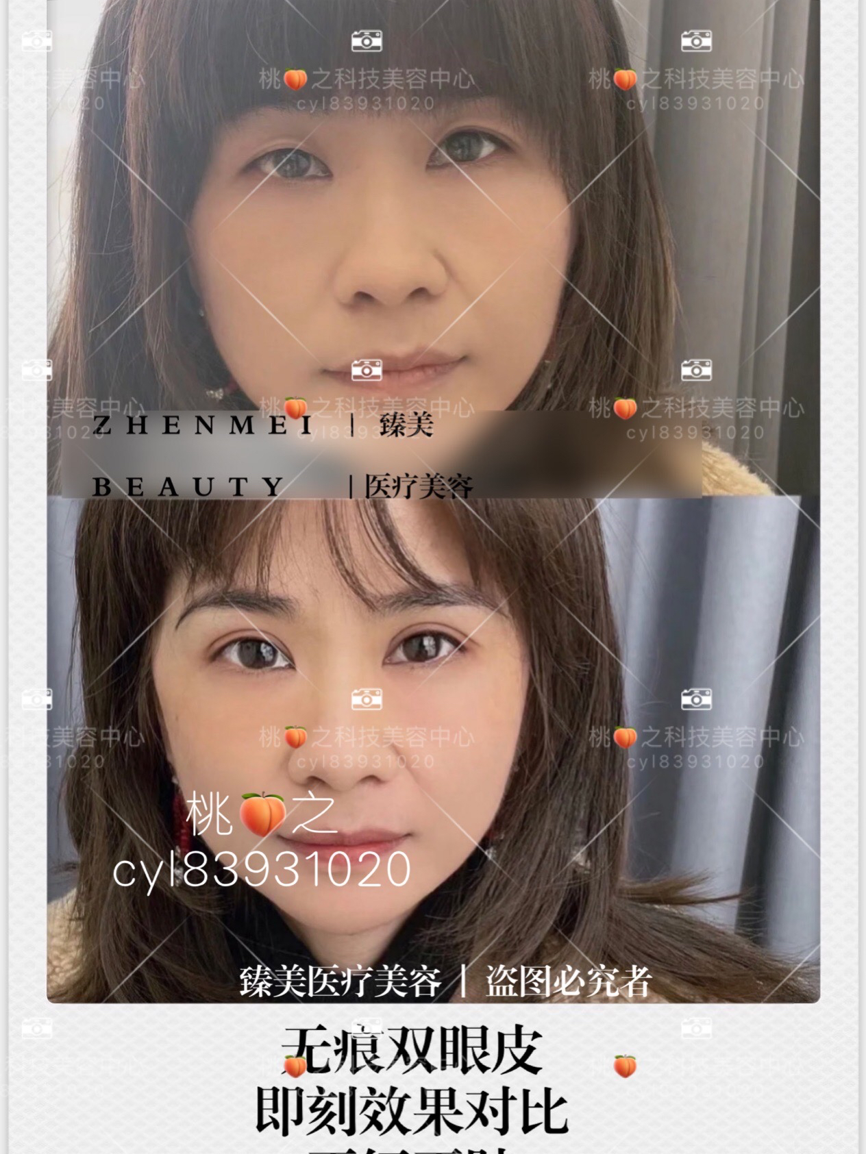 创新技术打造无痕双眼皮，自信之美的蜕变之路