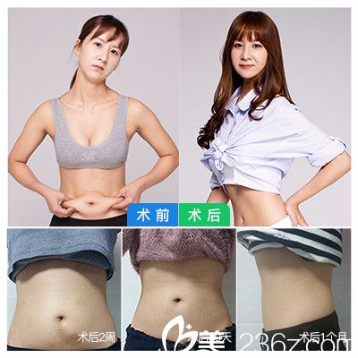 友情与陪伴的奇妙旅程中的抽脂隆胸价格探讨