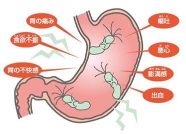小巷深处的健康秘密，幽门螺旋杆菌最新治疗方法探索