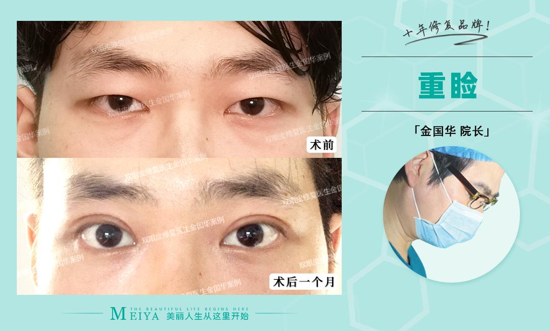 最新双眼皮技术观点论述与介绍