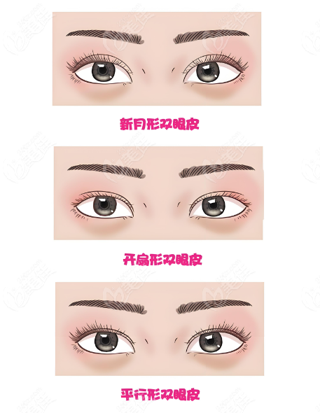 最新双眼皮技术观点论述与介绍